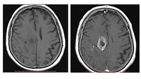 Ein MRT-Scan des zentralen Nervensystems verdeutlicht den Unterschied in der Bildgebung: ohne Anwendung eines Kontrastmittels (links) und mit Anwendung des Kontrastmittels. Credits: Guerbet GmbH  