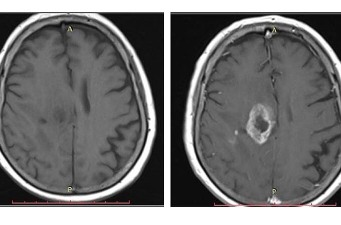 Ein MRT-Scan des zentralen Nervensystems verdeutlicht den Unterschied in der Bildgebung: ohne Anwendung eines Kontrastmittels (links) und mit Anwendung des Kontrastmittels. Credits: Guerbet GmbH  